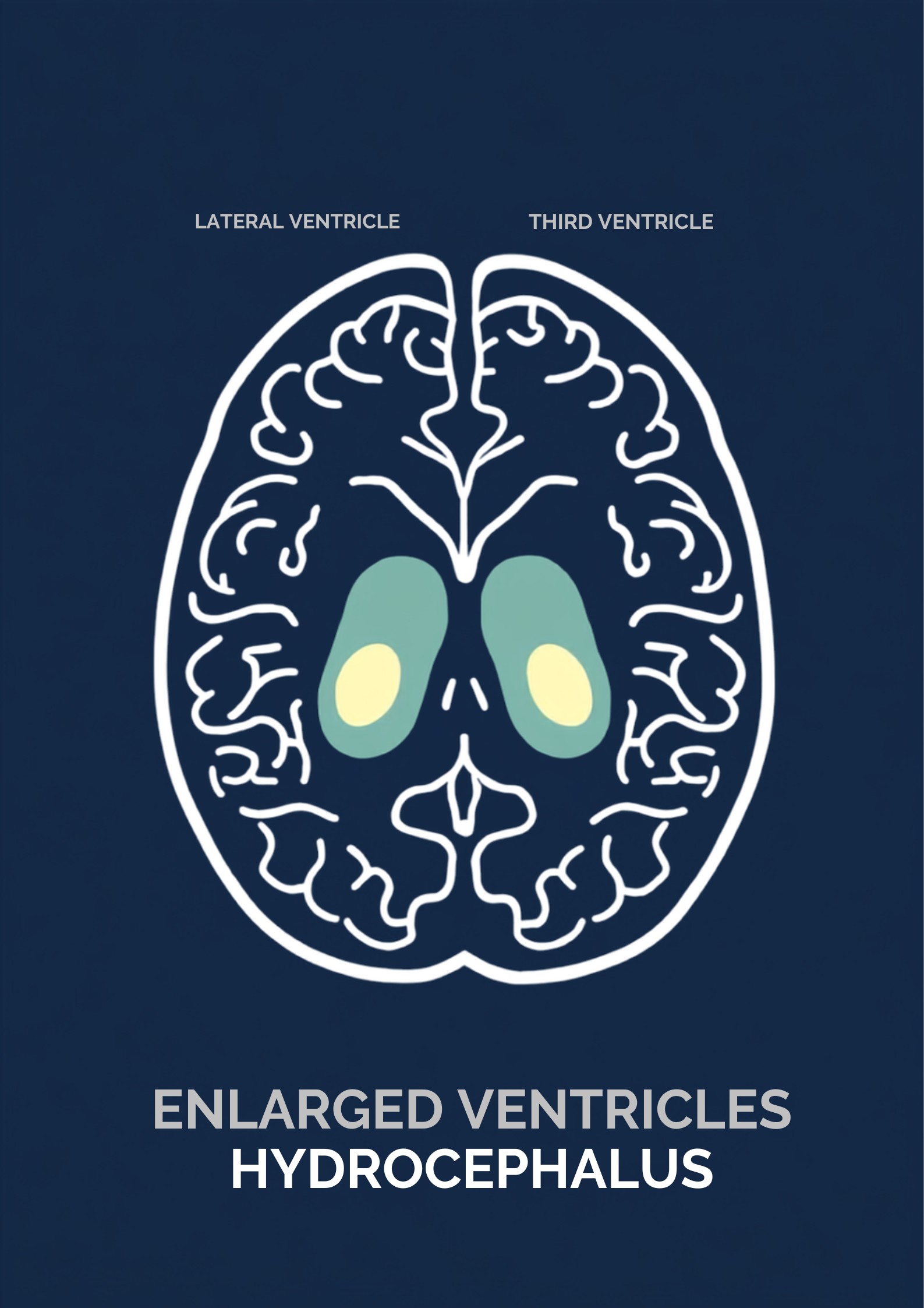 Medical illustration of a childs brain showing enlarged ventricles caused by hydrocephalus