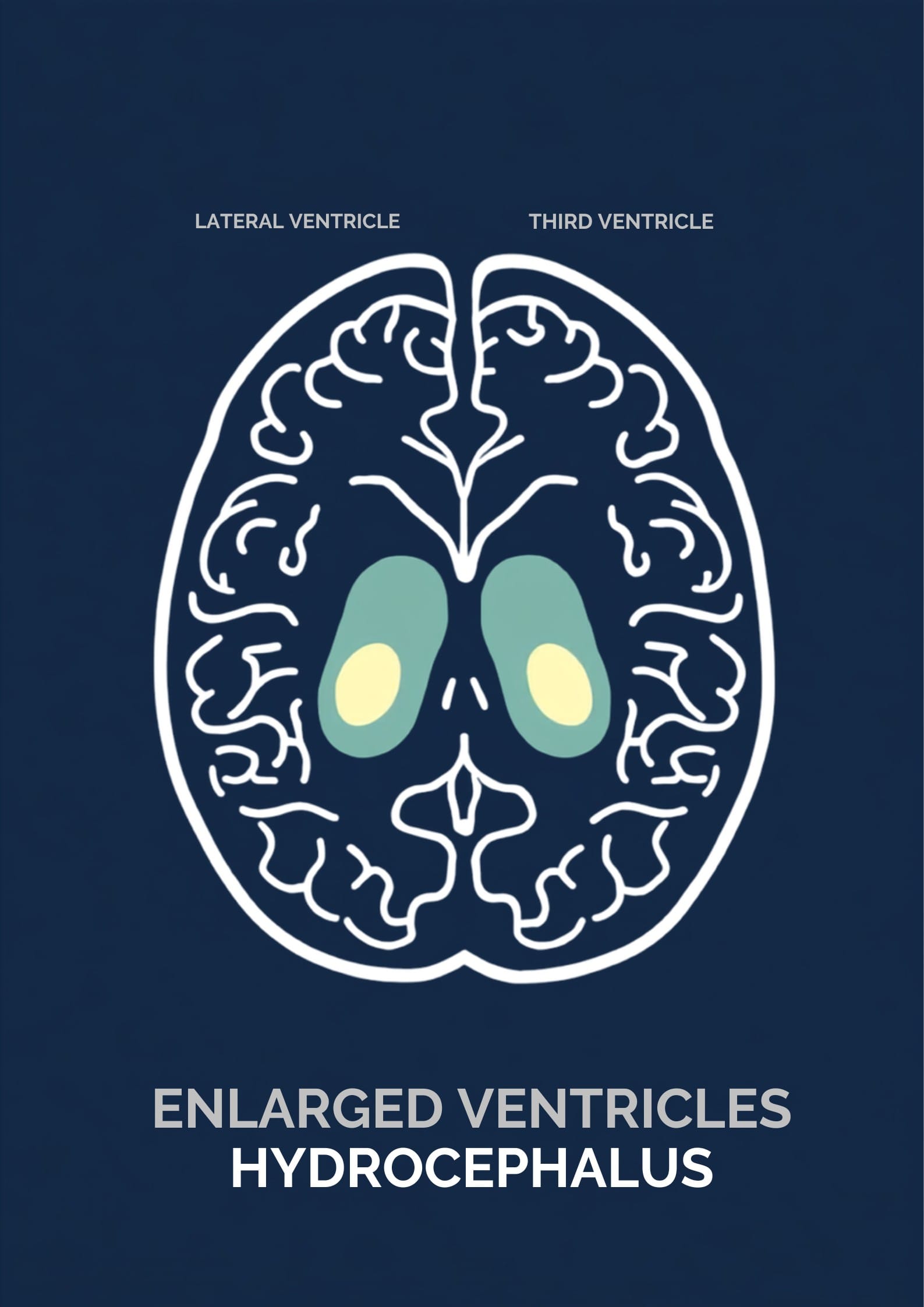 Medical illustration of a childs brain showing enlarged ventricles caused by hydrocephalus